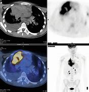 Image result for Hodgkin Lymphoma PET/CT