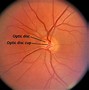 Image result for Enlarged Optic Nerve