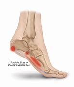 Image result for Heel Pain Plantar Fasciitis Sandals