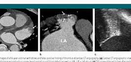 Image result for Cardiac CT Left Atrial Appendage Thrombus