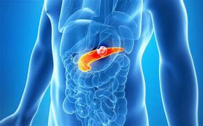 Image result for Pancreatic Cancer