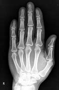 Image result for Jersey Finger X-ray