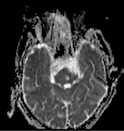 Image result for Diffusion MRI