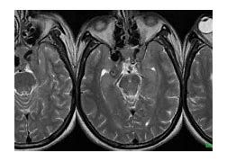 Image result for Aneurysm in MRI