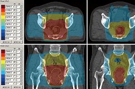 Image result for Radiotherapy Rectal Cancer