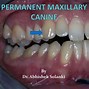 Image result for Maxillary Canine Pulp