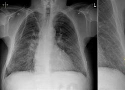 Image result for Acute Pulmonary Oedema Positioning