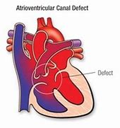 Image result for Atrioventricular Canal Defect Osmosis