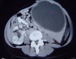 Image result for Cyst On Spleen