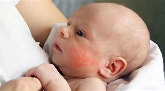 Image result for Eczema On Baby Arm