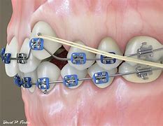 Image result for Propel Tooth Movement