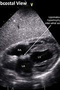 Image result for Interatrial Septum Lipomatous Hypertrophy Echo