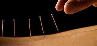 Image result for Acupuncture