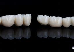 Image result for 3-Unit Bridge Front Teeth