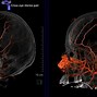 Image result for Meningeal Artery Anatomy