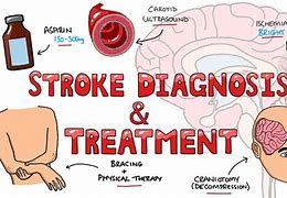 Image result for Stroke Cure