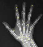 Image result for PA Finger X-ray