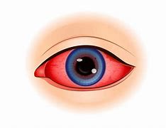 Image result for Uveitis Eye Disease