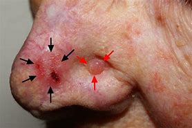 Image result for Basal Cell Carcinoma Cancer Symptoms