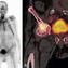 Image result for Sclerosis Bone Metastases X-ray