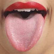 Image result for White Bumps On Tongue