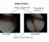 Image result for Meniscal Graft