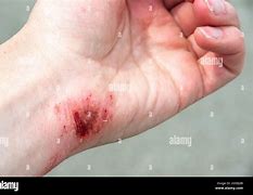 Image result for Wrist Laceration