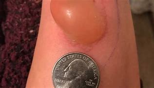 Image result for Spider Bite Pimple