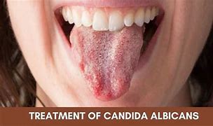 Image result for Candida Face