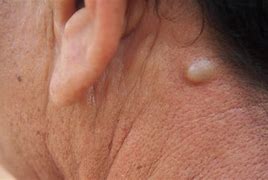 Image result for Cyst White Paste