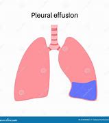 Image result for Pleural Effusion Images