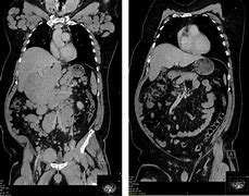 Image result for Pet Scan Lymphoma Example