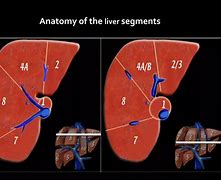 Image result for Abdomen CT Cor