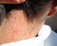 Image result for Candida Skin Rash Symptoms