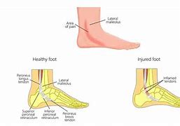 Image result for Peroneal Tendinopathy