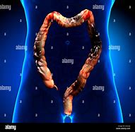 Image result for Human Body Colon Cancer