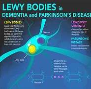 Image result for Dementia Picutre