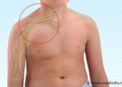 Image result for Brachial Plexus Fall Injury