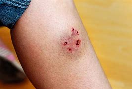 Image result for Dog Bite Injury Pics