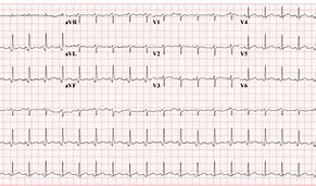 Image result for Pericarditis EKG Findings Example