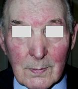 Image result for Rosacea Mites On Face