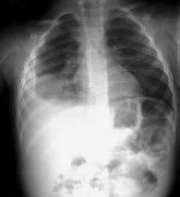 Image result for Childhood Pneumonia