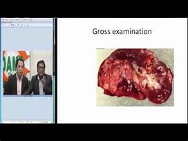 Image result for VHL Renal