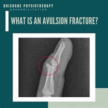 Image result for Avulsion Fracture