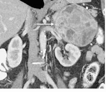 Image result for Pheochromocytoma On CT Scan