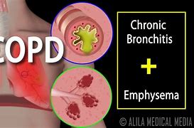 Image result for COPD 3D