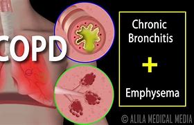 Image result for COPD Pinterest