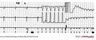 Image result for Ventricular Fibrillation EKG Examples