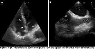 Image result for Right Atrial Appendage Aneurysm