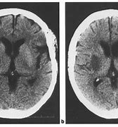 Image result for CT Brain Lentiform Nucleus